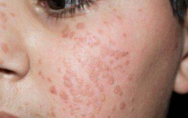 Papillomes plats sur le visage